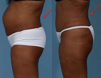 Rectus Diastasis (Abdominal Separation) Chicago
