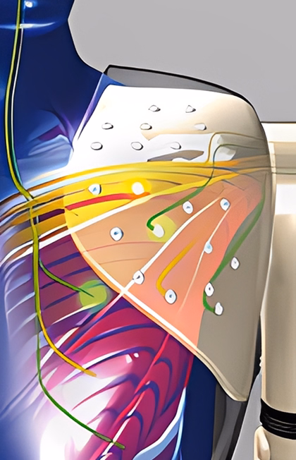 Targeted Muscle Reinnervation @ 2x